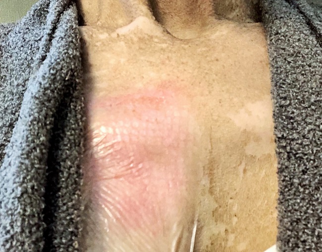 Image of my chest skin 100 days post stem cell transplant