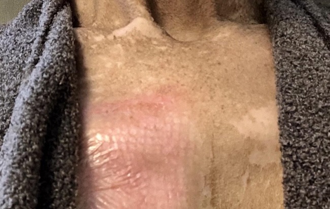 Skin after stem cell transplant